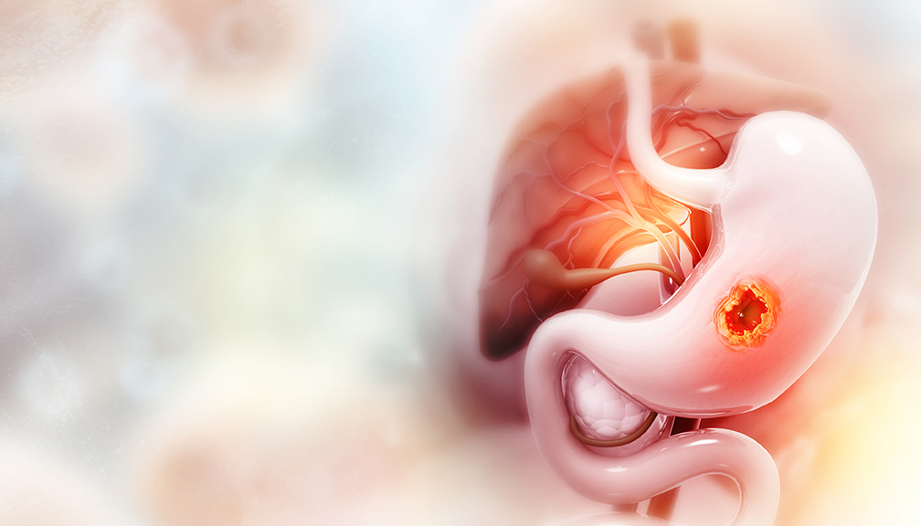 Illustration eines Magens mit sichtbarem Geschwür, medizinische Darstellung