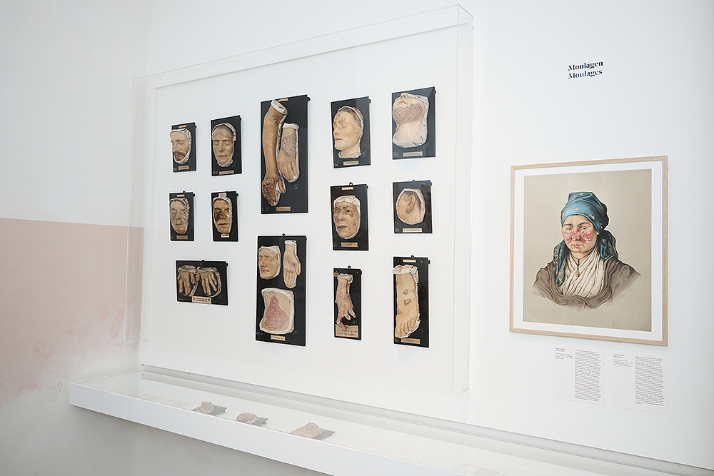 Historische medizinische Moulagen in einer Ausstellung, die verschiedene Körperteile und Hauterkrankungen darstellen.