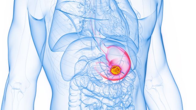 Medizinische Illustration des menschlichen Körpers mit hervorgehobenem Magenkrebs