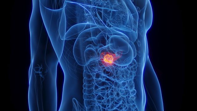 Medizinische Illustration eines Tumors in der Bauchspeicheldrüse