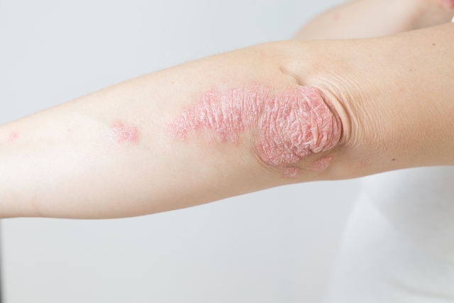 Nahaufnahme eines Ellenbogens mit psoriatischer Haut, die durch rote, schuppige Flecken gekennzeichnet ist.