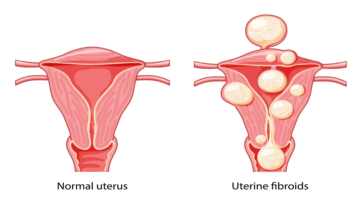 Menschliche medizinische Darstellung des Uterus mit isolierter Zervix und Eileitern.