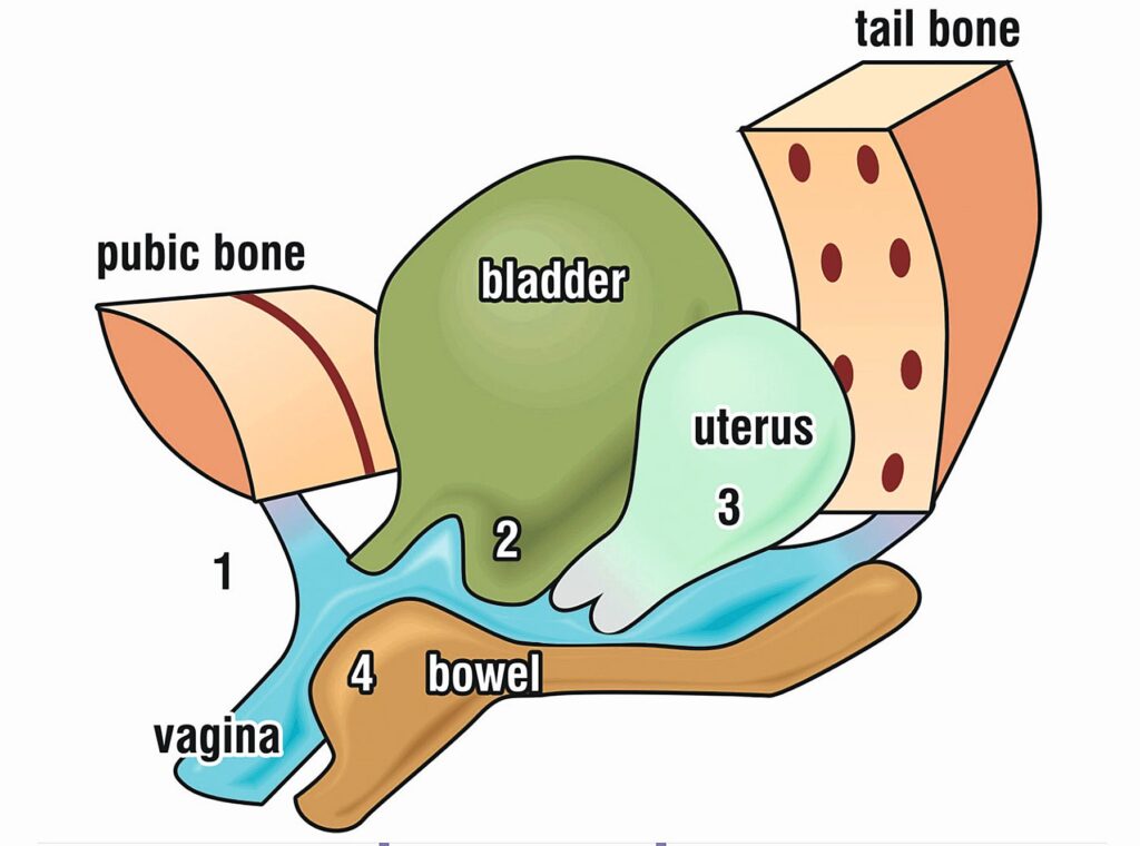 Schematische Darstellung des weiblichen Beckenbodens mit Blase, Uterus und Darm sowie den zugehörigen Funktionsstörungen wie Inkontinenz und Prolaps.