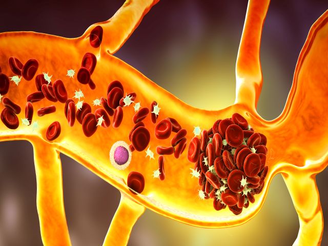 Darstellung der Blutgerinnung mit einem Thrombus in einem Blutgefäß