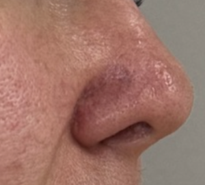 Nahaufnahme einer Nase nach einer Behandlung mit sichtbarer Verbesserung der Hautstruktur.