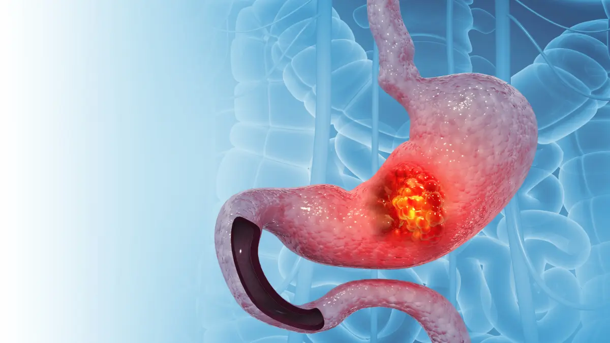 Darstellung eines Magens, der rot ist