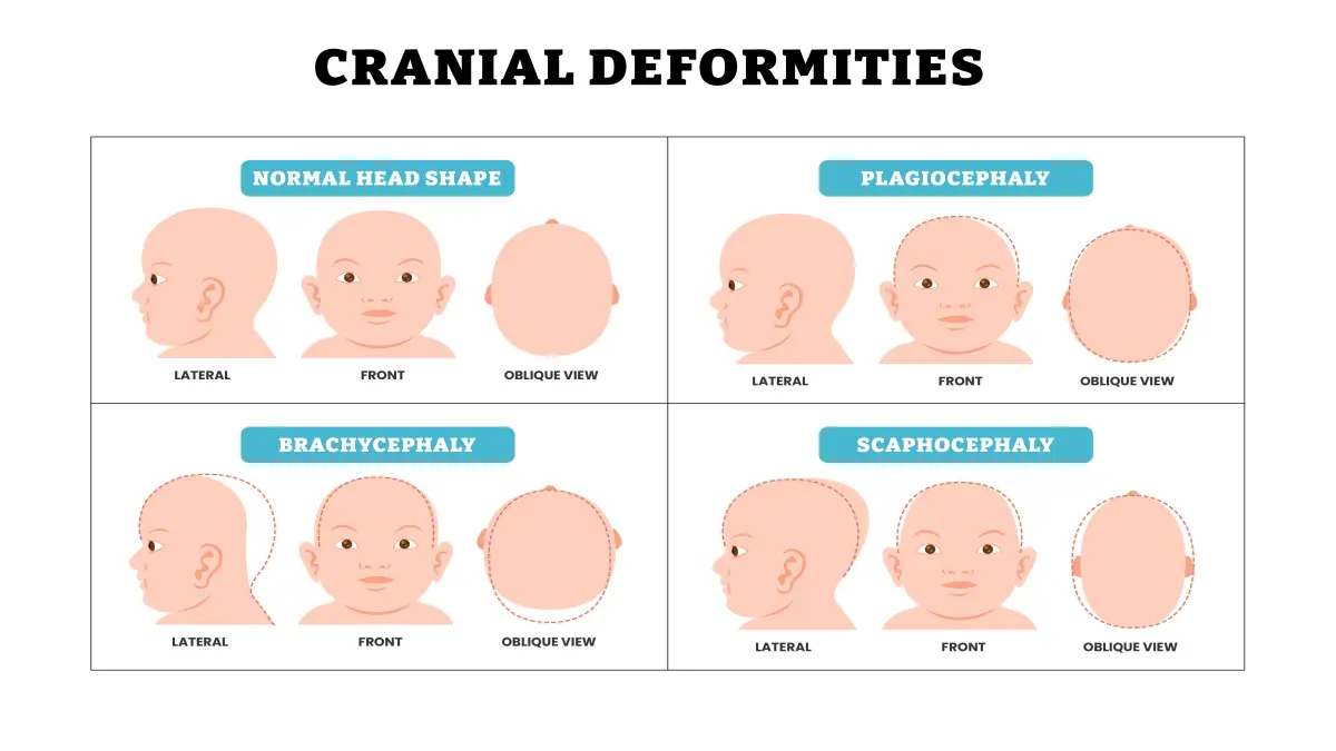 Schematische Darstellung von verschiedenen Arten von Schädeldeformitäten bei Babys/Kleinkindern, es werden Plagiozephalie, Brachyzephalie und Skaphozephalie in Seiten-, Vorder- und Seitenansicht dargestellt.