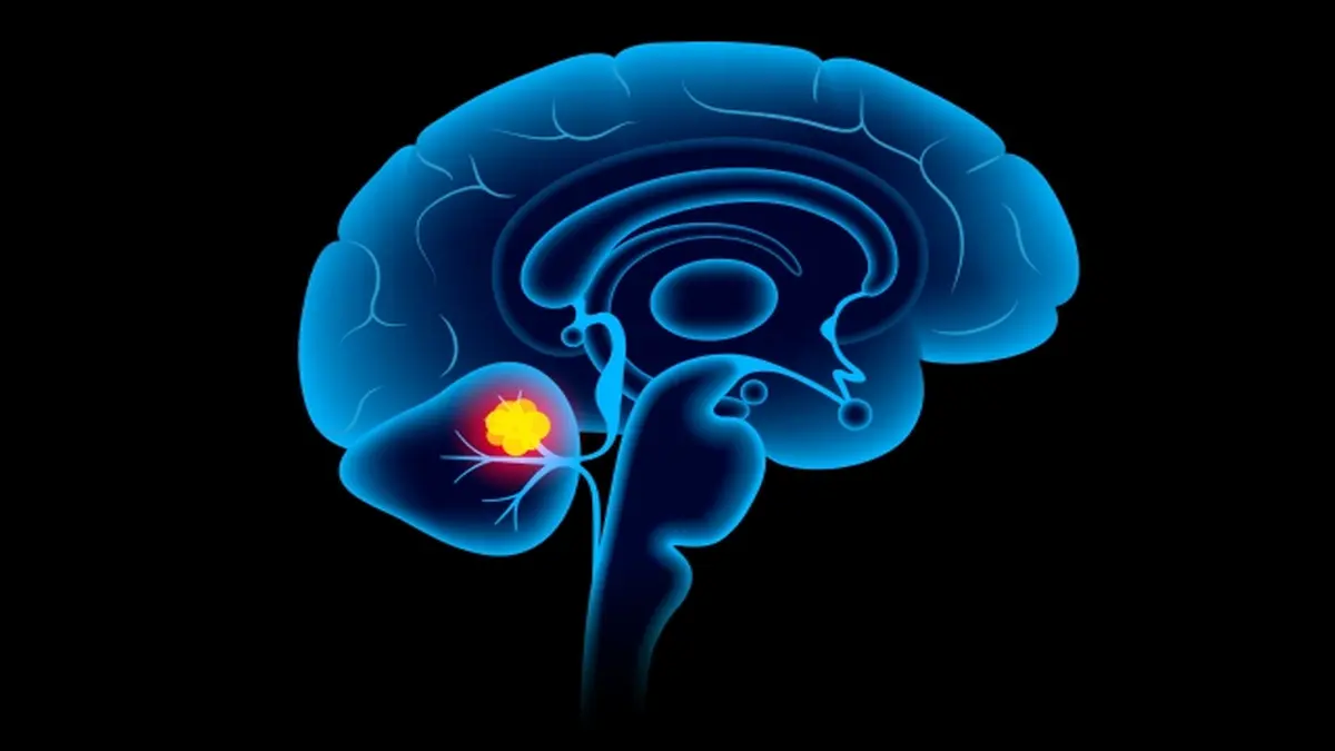 Wissenschaftliche Darstellung eines Gehirns mit hervorgehobenem Medulloblastom im Kleinhirn, symbolisiert die Fortschritte in der Therapie durch CRISPR und DNMT1-Inhibitoren.
