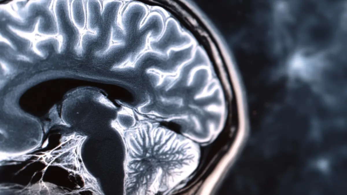 Multiple Sklerose hirnscan graue substanz