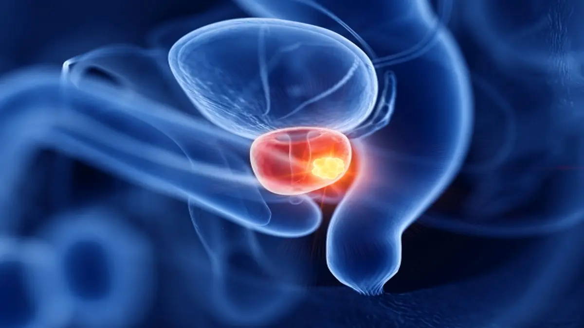 wissenschaftliche Darstellung der Prostata mit einem hervorgehobenen Tumor. Es symbolisiert die Ergebnisse der VERSUS-Studie, die sich mit Prostatakrebs bei jungen Patienten unter 45 Jahren beschäftigt