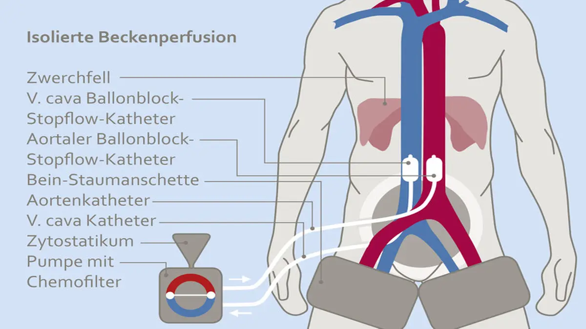 Schema der isolierten hypoxischen Beckenperfusion (HPP)