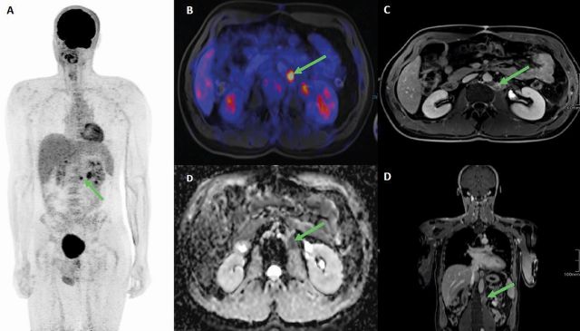 Abb. 1: Abdominales FDG-PET / MRI eines retroperitonealen Resttumors bei metastasiertem Seminom nach Chemotherapie. A: Invertierte maximale Intensitätsprojektion (MIP) eines Ganzkörper-PET / MRI mit einem paraaortalen Lymphknoten (grüner Pfeil). B: Transversale Aufnahme des abdominellen PET / MRI in Fusionssequenz mit hoher FDG-Aufnahme aufgrund eines erhöhten Stoffwechsels (grüner Pfeil). C: Transversales Bild des abdominalen PET / MRT in T1-Sequenz mit hyperintensen Lymphknoten nach Kontrastmittelgabe (grüner Pfeil). D: Transversales Bild des abdominalen PET / MRI in DWI-Sequenz mit hypointensem Lymphknoten (grüner Pfeil). E: Koronares Bild in T1-Sequenz mit hyperintensen Lymphknoten nach Kontrastmittel.