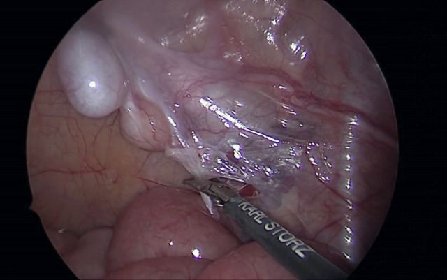 Abb. 1: Fowler-Stephens-Technik (zweiter Eingriff): Durchtrennen der im Rahmen des ersten Eingriffes unterbundenen Samenstranggefäße
