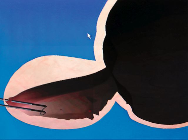 Abb. 2: TURP-Simulator. Zusatzmonitor, der im Simulatortraining Fortschritt und Tiefe der Resektion zeigt, Informationen, die in der Realität nicht verfügbar sind.