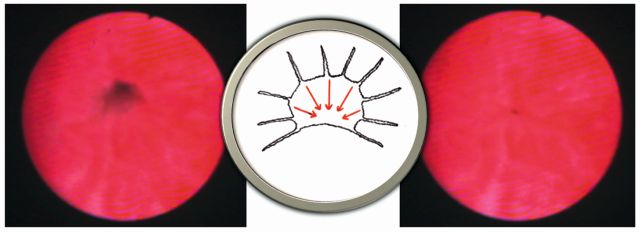 Abb. 2: Endoskopisches Bild des Sphinkter urethrae externus (leicht geöffnet links, geschlossen rechts) mit schematischer Darstellung zur konzentrischen Tonisierung (Mitte)