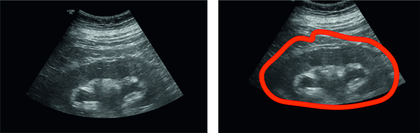 Abb. 2: Anwendung des AlexNet-Modells in der Detektion der Nierenbeckenkelch­ektasie