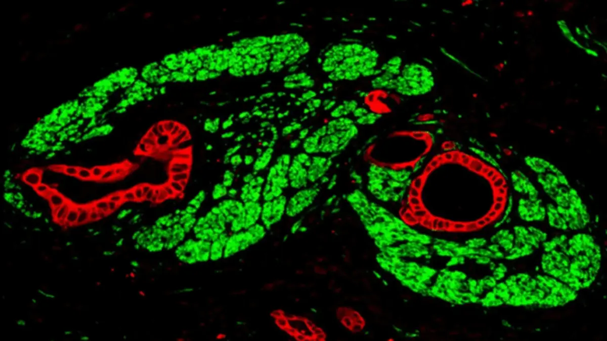 Bauchspeicheldrüsenkrebs in einer Immunofluoreszenz-Aufnahme: Die Tumorzellen sind rot, die von Tumorzellen befallenen Nerven grün markiert.