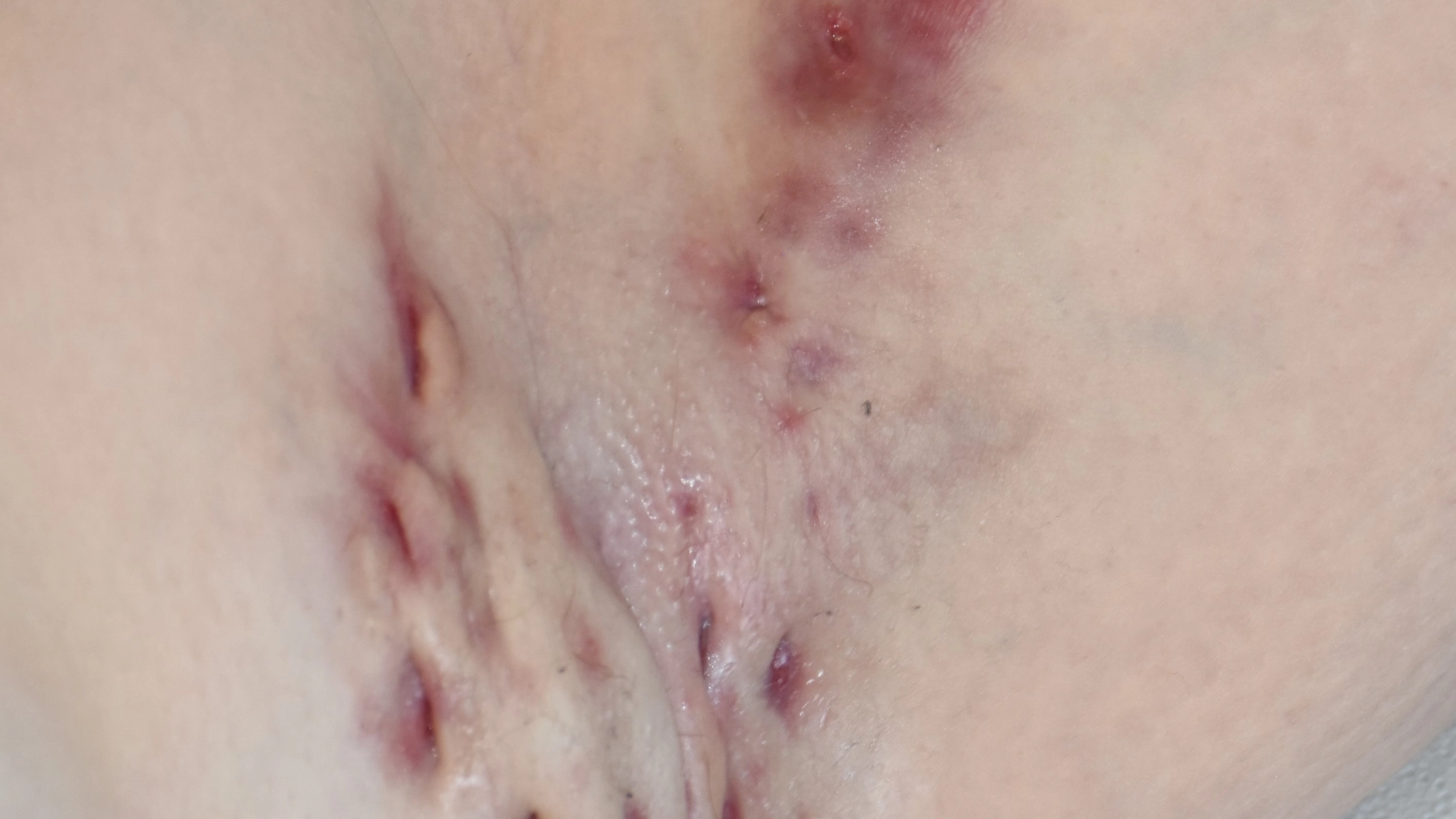 Acne inversa Hurley II