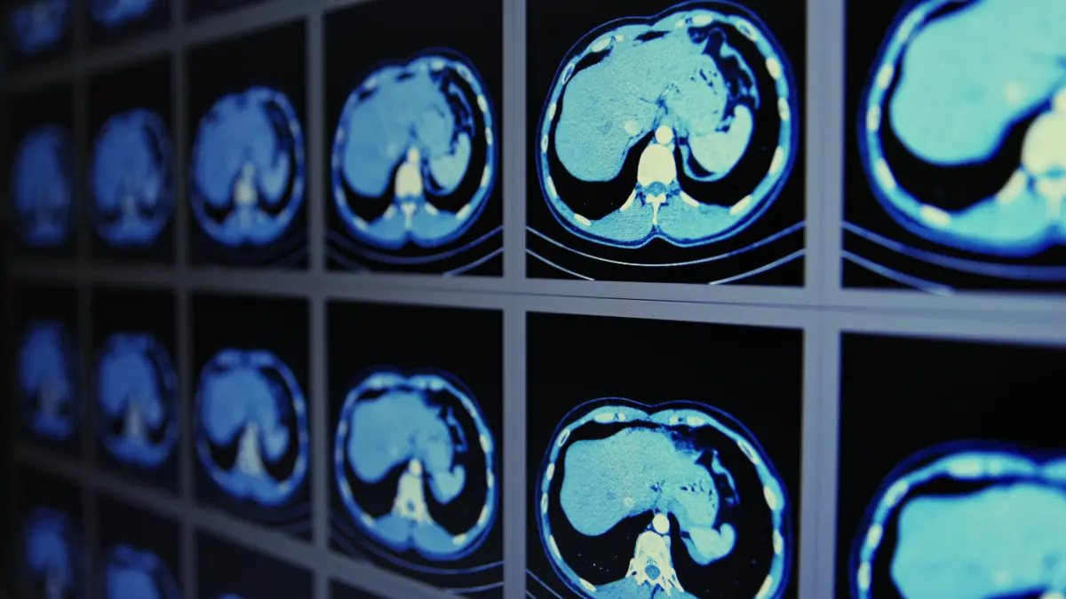 CT-Scans des Bauchraums zeigen detaillierte medizinische Aufnahmen zur Krebsdiagnostik.