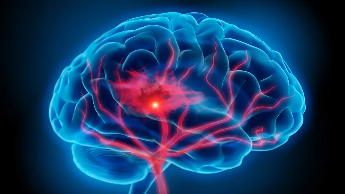 Medizinische Illustration eines Gehirns mit hervorgehobenen Blutgefäßen und einem roten Punkt, der ein Blutgerinnsel und einen Schlaganfall darstellt.
