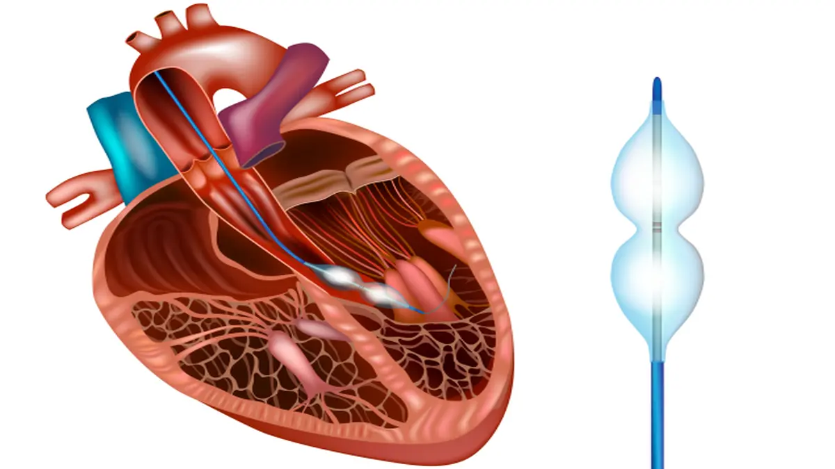 Medizinische Illustration eines menschlichen Herzens mit einem Katheter und einem Ballon zur Darstellung einer Ballondilatation.