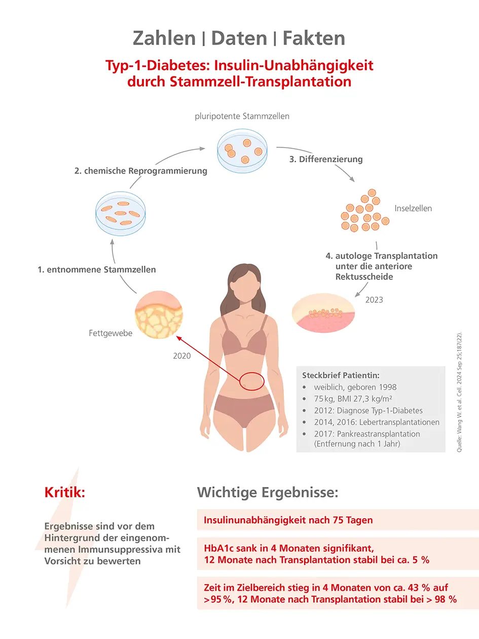 Typ-1-Diabetes: Insulin-Unabhängigkeit durch Stammzell-Transplantation