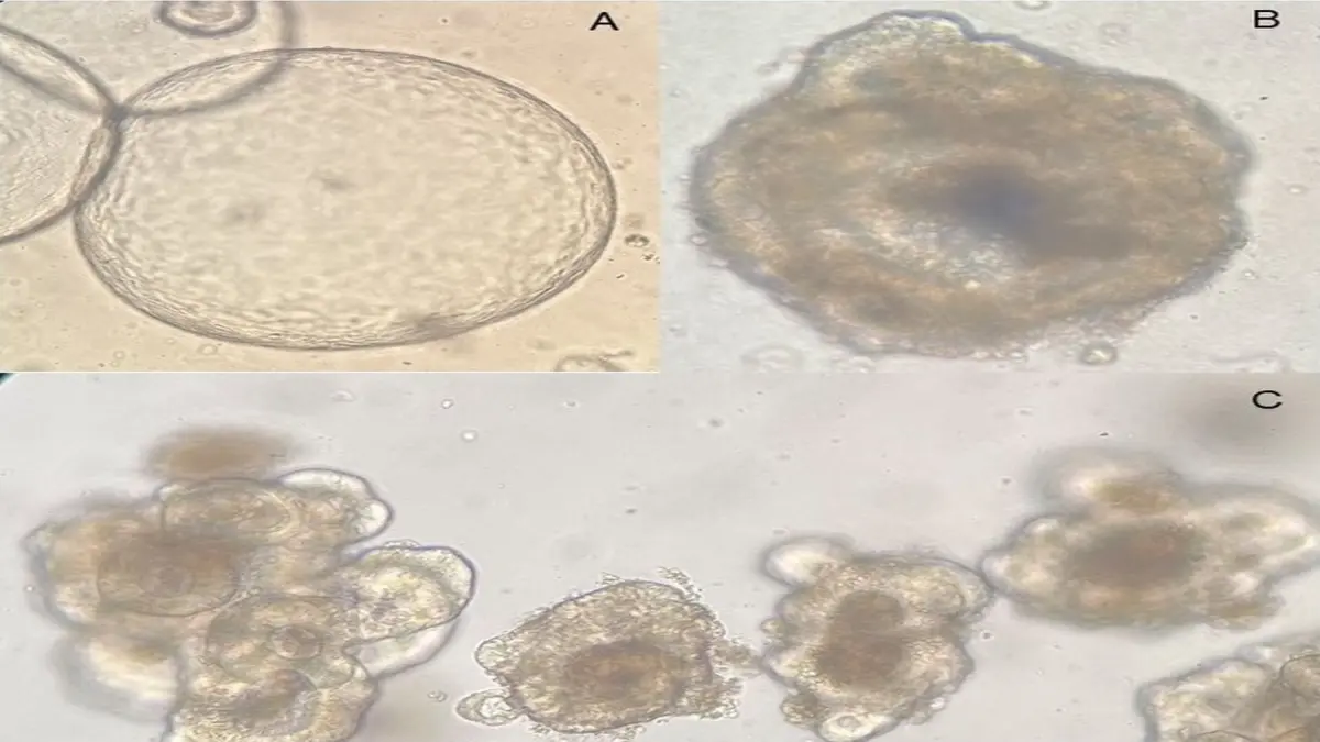 Mikroskopische Aufnahme von Mini-Tumoren (Organoiden) aus Darmkrebsgewebe, die für die personalisierte Therapie getestet werden.