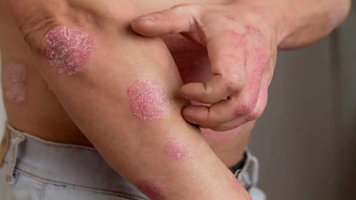 Nahaufnahme von entzündeten und schuppigen Hautstellen, die typisch für Psoriasis sind, symbolisiert die Herausforderungen und die moderne Therapie.