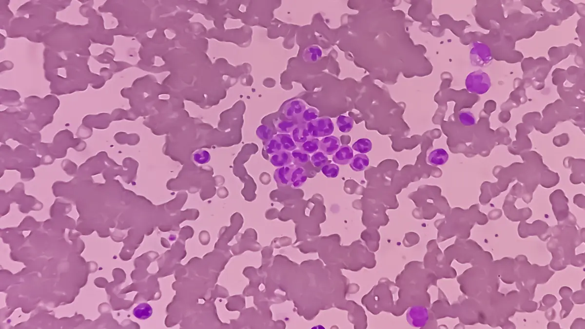 Mikroskopische Aufnahme von Erythrozyten, die für die Diagnostik und Therapie der Kälteagglutinin-Krankheit (CAD) relevant sind.