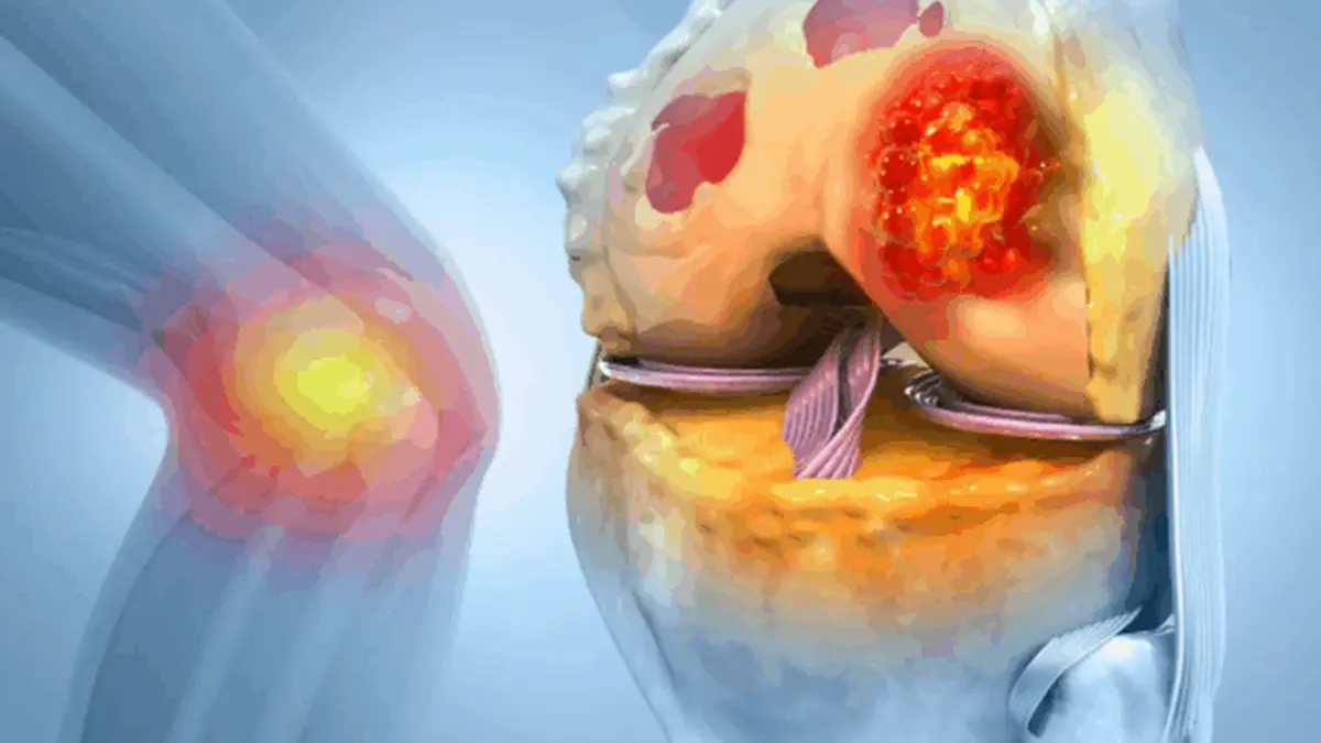 3D-Illustration eines menschlichen Kniegelenks mit einem auffälligen Tumor, der einen tenosynovialen Riesenzelltumor (TGCT) darstellt.