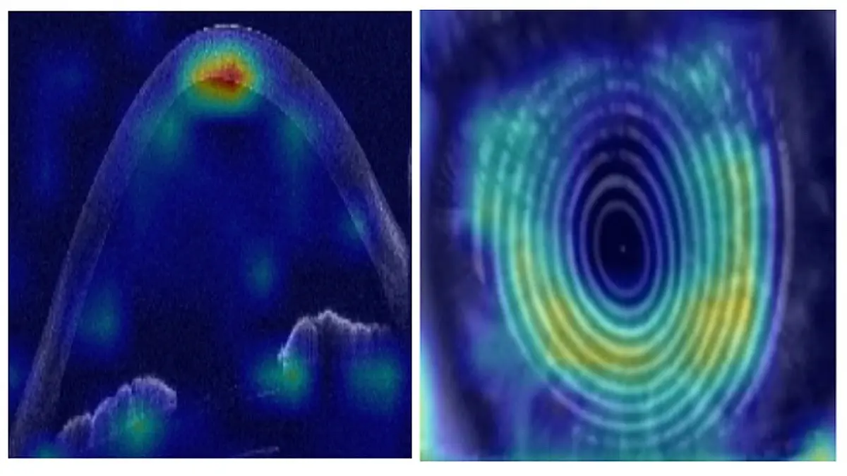 Beispiel eines von der KI verwendeten OCT-Scans des Auges. Foto: Shafi Balal / ESCRS