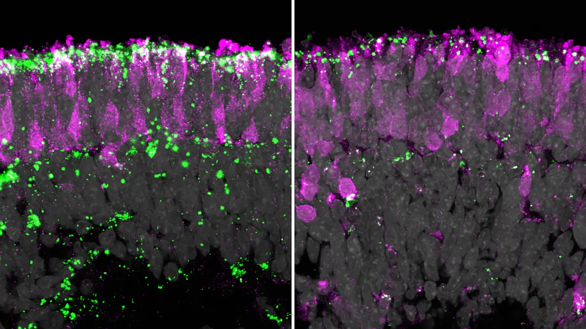 Das Bild links zeigt das Netzhautorganoid mit den für die CLN2-Erkrankung typischen toxischen Lipofuszinablagerungen (grün), die die Photorezeptoren (rosa) beeinträchtigen. Rechts sind nach der Gentherapie fast keine Ablagerungen mehr zu sehen. Foto: Kevin Achberger