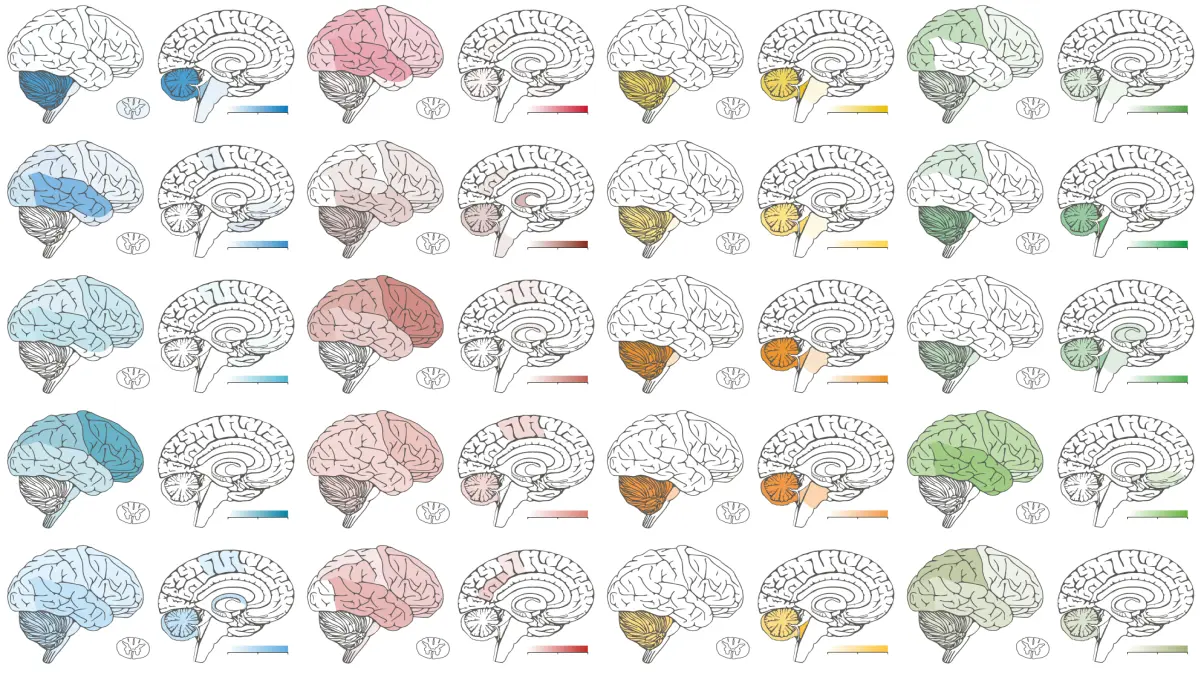 Illustration von Gehirnen mit farblich markierten Regionen, die verschiedene Methylierungsprofile darstellen, zur präzisen Diagnostik von Hirntumoren.