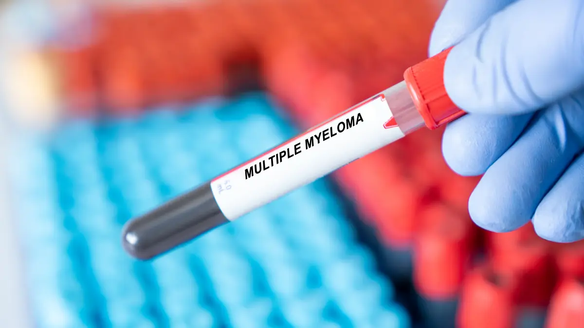 Blutprobe mit der Aufschrift „Multiple Myeloma“, die auf Forschung und Diagnose der Erkrankung hinweist.