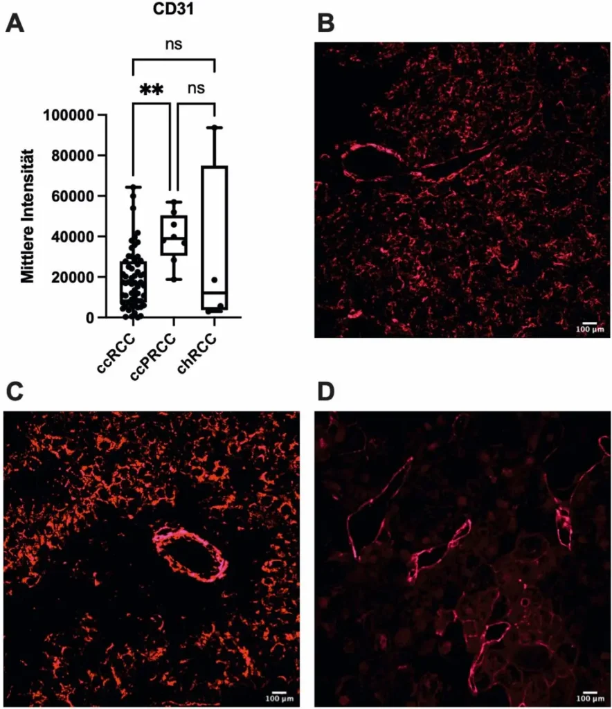 Abb. 1: Graphische und konfokalmikroskopische Darstellung der Immunfluoreszenz von CD31 (pink / rot). A: Immunfluoreszente mittlere Intensität von CD31; B: klarzelliges NZK n = 58; C: papilläres NZK n = 8; D: chromophobes NZK n = 4; n. s. Unterschied zwischen den verschiedenen Tumorentitäten; **p