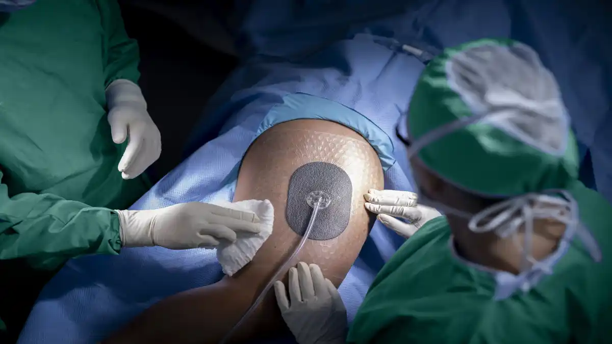 Das Bild zeigt Chirurgen im OP-Saal bei der Anwendung des V.A.C.® Peel and Place Verbands in der Unterdruck-Wundtherapie