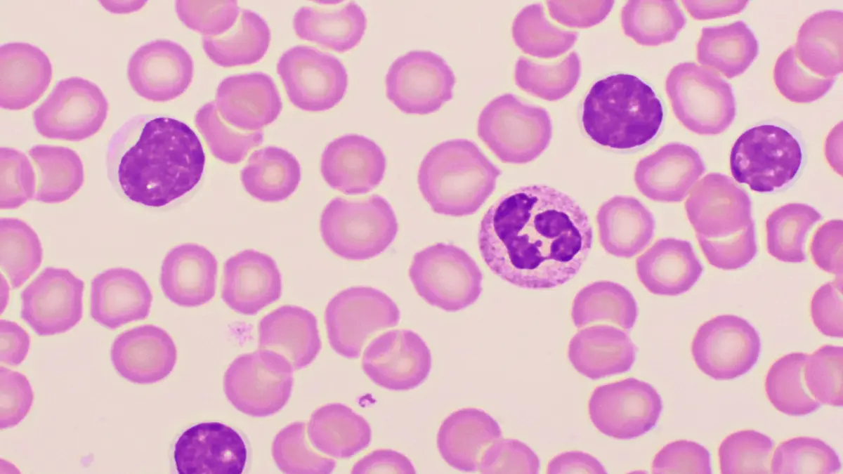 Mikroskopische Aufnahme von Blutzellen bei chronisch lymphatischer Leukämie