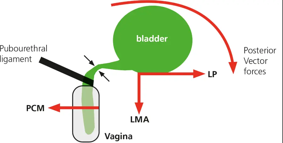 Abb. 1: Längschnitt durch Urethra und Blase mit schematischer Darstellung der wichtigen Muskelvektoren: M. pubococcygeus (PCM) nach Zug nach ventral, Levatorplatte (LP) nach dorsal und longitudinaler Muskel des Anus (LMA) nach kaudal. Bei intaktem pubourethralem Ligament, das von retropubisch paraurethral zur Vagina in Höhe der mittleren Urethra führt, entsteht Belastungskontinenz, in dem durch Zug nach vorne (PCM) und Zug nach dorsokaudal (LP und LMA) die proximale Urethra gedehnt und abgeknickt wird. Das ermöglicht Kontinenz auch bei großer Belastung. (von P. Petros mit Genehmigung)