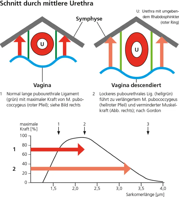 Abb. 2: Ein Querschnitt durch die mittlere Urethra zeigt die Lagebeziehung zwischen Symphyse (schwarz), Vaginalwand (blau), pubourethralem Ligament (grün), M. pubococcygeus (rote Pfeile) und dem Rhabdosphinkter (roter Ring). Bei normal langen pubourethralen Ligamenten (Position 1) weist der M. pubococcygeus die optimale Länge auf und die Muskelkrft ist maximal (siehe Kurve rechts). Verlängern sich die pubourethralen Ligamente (hellgrün in Position 2), verlängert sich auch der M. pubococcygeus, der drastisch an Muskelkraft verliert (siehe Kurve rechts). Eine Reposition durch Simulation oder ein spannungsfreies mitturethrales Band normalisiert die Muskelkraft unmittelbar und es entsteht Belastungskontinenz.