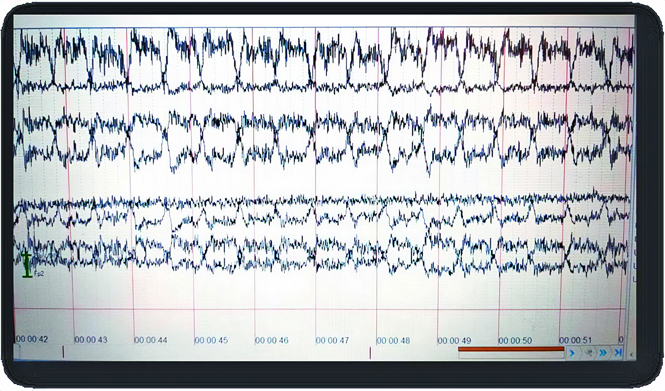 Abb. 3 : Nicht auswertbares, Artefakt-gestörtes EEG durch parallel laufende IMPELLA. Die EEG-Ableitung erfolgte nach den Vorgaben der Richtlinie zur Feststellung des irreversiblen Hirnfunktionsausfalls (5. Fortschreibung; Wissenschaftlicher Beirat der Bundesärztekammer, 2022) sowie der spezifischen technischen Vorgaben der Deutschen Gesellschaft für klinische Neurophysiologie (DGKN).