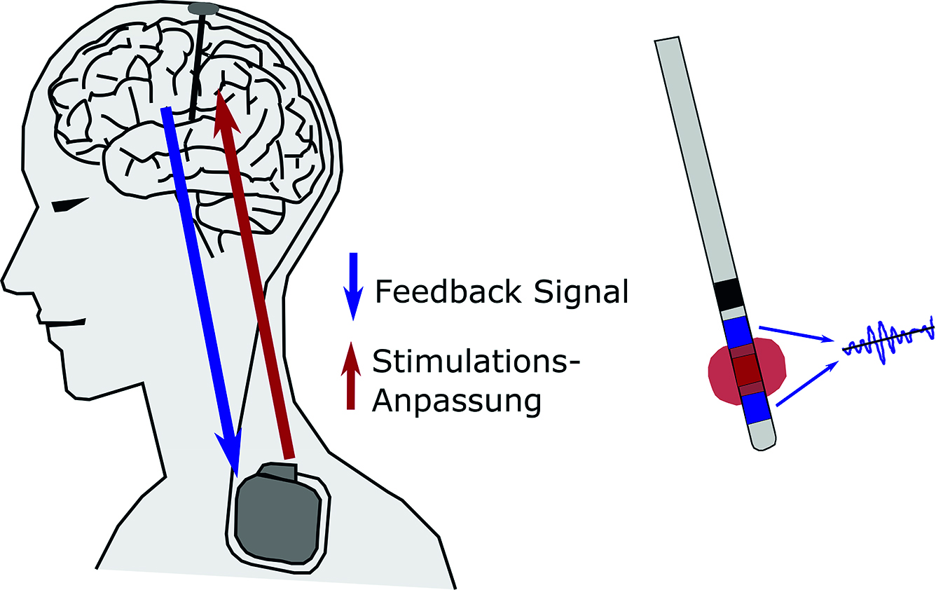 Abb. 2: Adaptive Tiefe Hirnstimulation