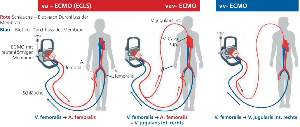 Abb. 1: Übersicht der peripheren ECMO-Typen. Links die beiden Verfahren zur Unterstützung bei kardialer (ECLS/va-ECMO)- und kardiopulmonaler (vav-ECMO) Funktionseinschränkung, rechts das rein pulmonale Unterstützungsverfahren (vv-ECMO); mod. nach [9].