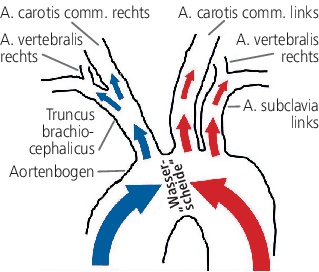 Abb. 2 : Darstellung der „Wasserscheide“ bei retrogradem Fluss des ECMO-Blutes bei va-ECMO und Affektion der hirnversorgenden Gefäße. Harlekinphänomen bei differenter Oxygenierung zwischen rechter und linker Hemisphäre.