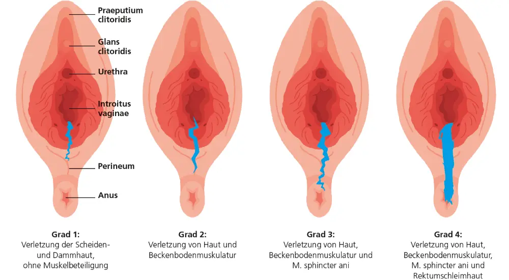 Abb. 1: Schematische Darstellung der weiblichen vulvovaginalen und perinealen Anatomie mit Einteilung der Dammverletzungen
nach Schweregrad (Grad 1–4). © inspiring.team – stock.adobe.com (modifiziert).