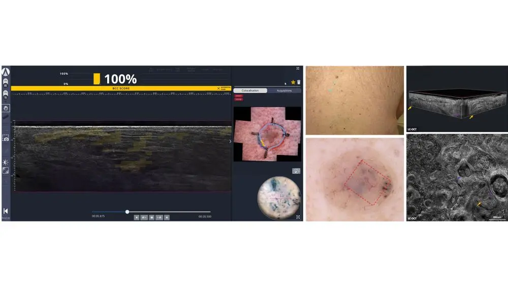 Quadranten-basierte Randbeurteilung. Durch standardisierte Segmente können LC-OCT-Befunde, Ex-vivo-Bildgebung und Histologie
präzise miteinander verglichen werden; @ Damae Medical