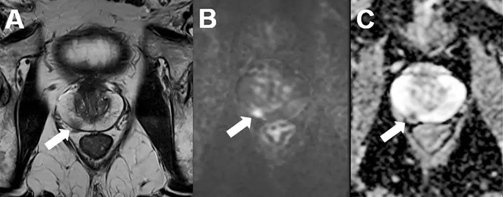Abb.: Multiparametrische MRT (mpMRT) der Prostata
Axiale Schichtung einer mpMRT mit karzinomsuspektem Befund in der peripheren Zone rechts (PIRADS 4) in der T2-Sequenz (A) mit Nachweis einer Diffusionsstörung (B+C). Die daraufhin durchgeführte MRT-TRUS-Fusionsbiopsie der Prostata ergab ein Prostatakarzinom mit einem Gleason-Score 3 + 4 = 7a (Gleason 4-Anteil: 10 %). (mit freundlicher Genehmigung von Dr. med. Daniel Vogele, Klinik für Diagnostische und Interventionelle Radiologie, Universitätsklinikum Ulm)