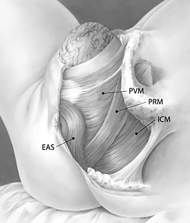 Anatomische Darstellung der weiblichen Beckenbodenmuskulatur im Sagittalschnitt. Sichtbar sind der Musculus pubovisceralis (PVM), Musculus puborectalis (PRM), Musculus iliococcygeus (ICM) sowie der äußere Analsphinkter (EAS). © Vila Pouca MCP et al., 2022