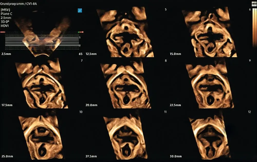 Abb. 3: Levatoravulsion in der Sono-CT 3-D-Rekonstruktion, Ultraschallgerät Samsung
HERA W10 Elite, Area of hiatal dimension von 32 cm². (© Bader W, Klinikum
Bielefeld)