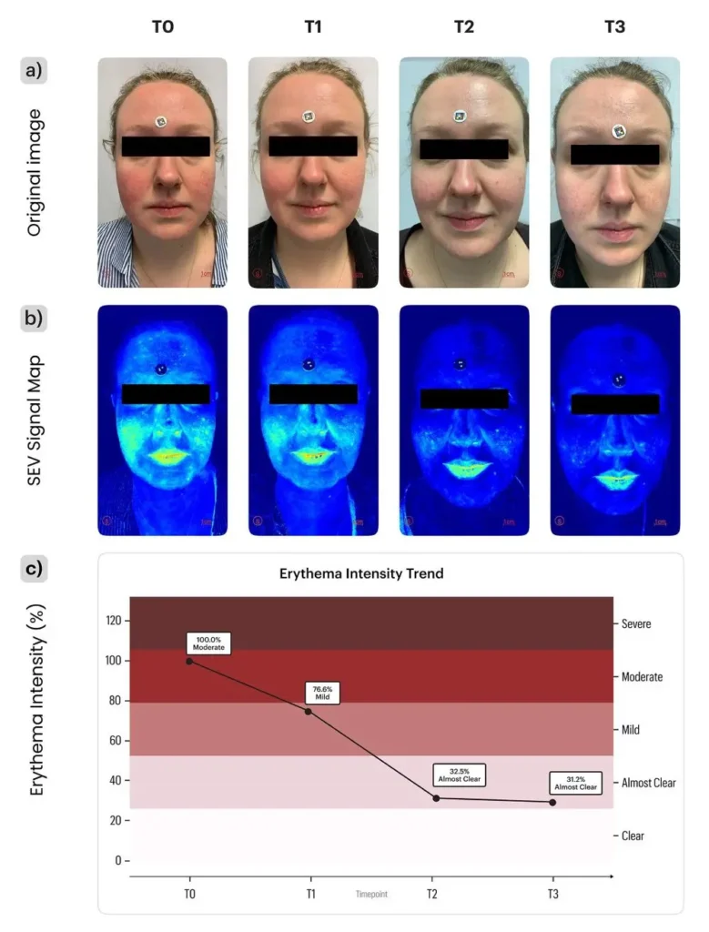 BU: Composite figure showing (a) the original image, (b) the corresponding SEV signal map. (c) the graphical representation of the erythema intensity trend; © Supplementary graphics and patient images, with source attribution (SCARLETRED Holding GmbH, Vienna, Austria, and Department of Dermatology, Universitätsklinikum Tuebingen, Tuebingen, Baden-Wuerttemberg, Germany).