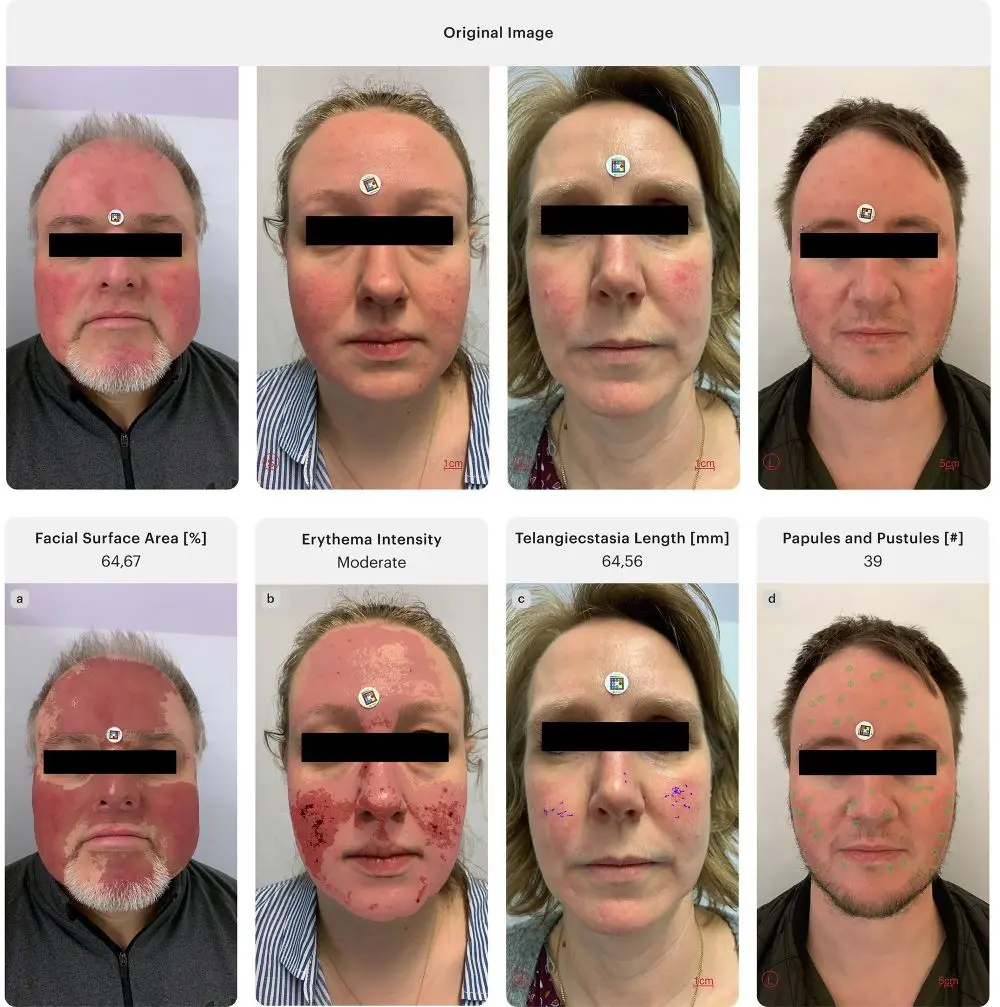 Representative images corresponding to the evaluation of specific clinical parameters. Each image highlights one feature: affected area (a), erythema intensity (b), telangiectasia c), and papules/pustules (d); © Supplementary graphics and patient images, with source attribution (SCARLETRED Holding GmbH, Vienna, Austria, and Department of Dermatology, Universitätsklinikum Tuebingen, Tuebingen, Baden-Wuerttemberg, Germany).